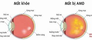 Hoàng Thể Thoái Hoá