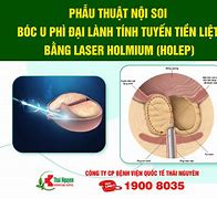 Phì Đại Tuyến Tiền Liệt Là Bị Gì